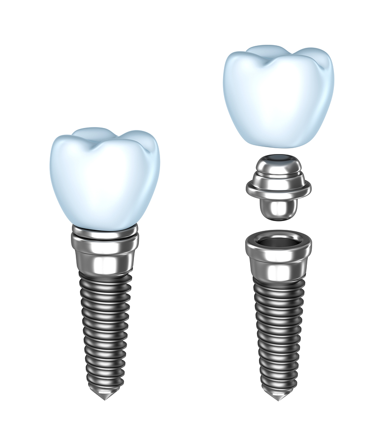 dental implants | Dentist in Yonkers, NY | General, Cosmetic and Implant Dentistry